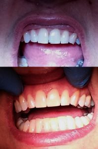 ricostruzione dente incisivo